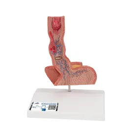 Diseases of the Esophagus Model