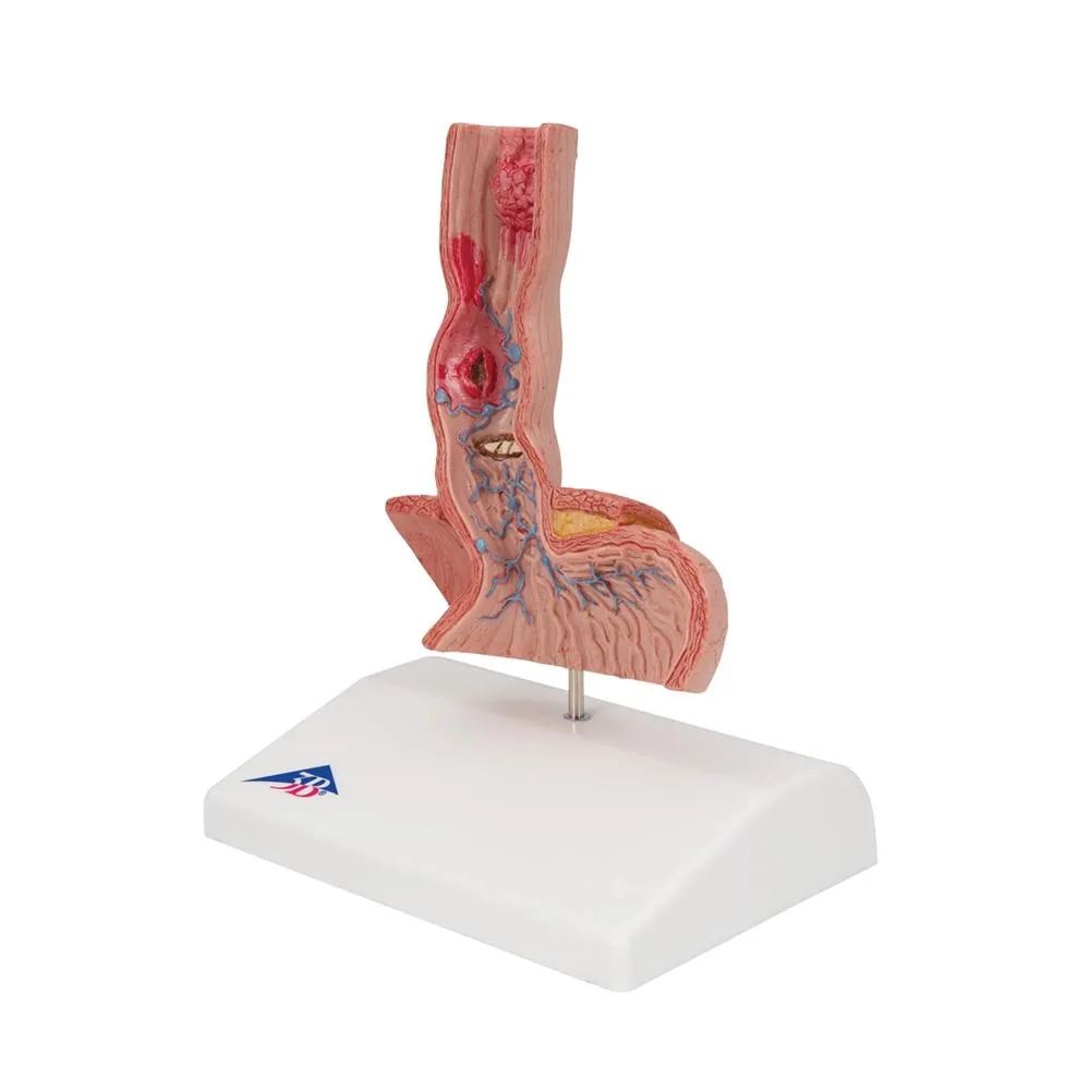 Diseases of the Esophagus Model